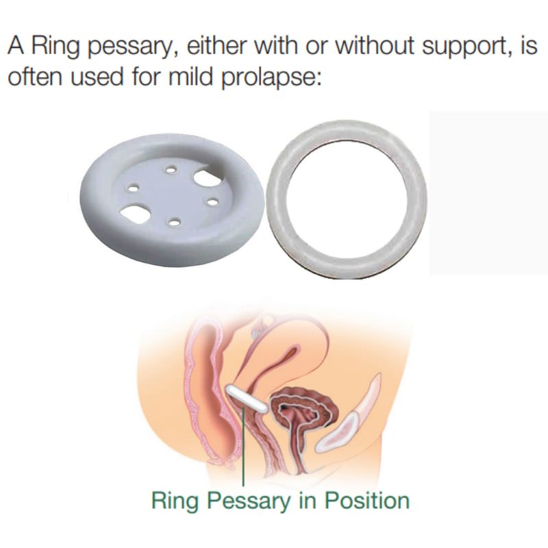 EvaCare Ring Pessary thumbnail 2