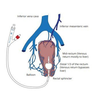 The Macy Catheter Rectal Medication Administration System, Bedside Care Kit thumbnail 3