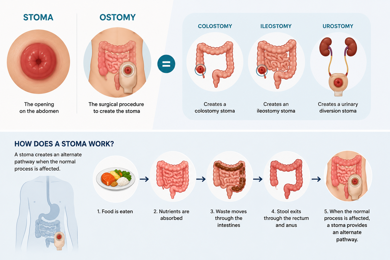 Difference Between a Stoma and an Ostomy