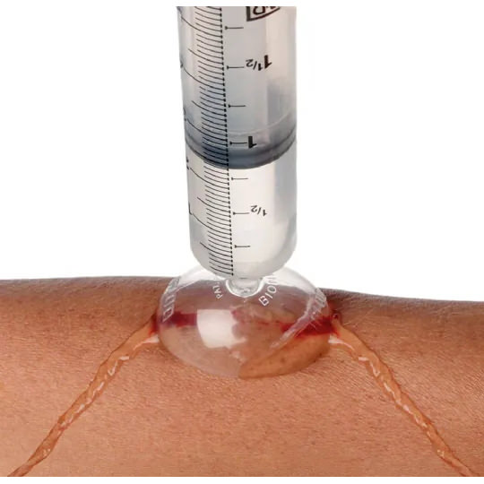 Bionix Igloo Wound Irrigation Shields thumbnail 4