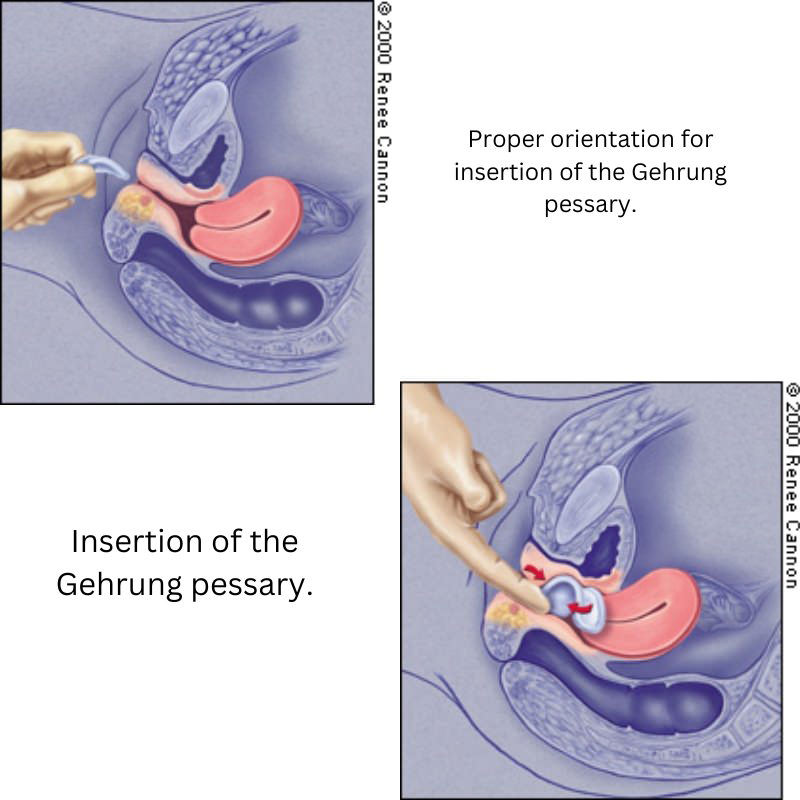 EvaCare Silicone Gehrung Pessary With Support thumbnail 2
