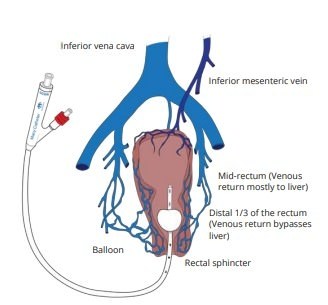 The Macy Catheter Rectal Medication Tube thumbnail 3