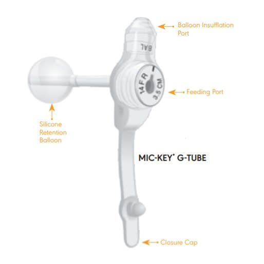 Mic-Key Gastrostomy Feeding Tube Kit thumbnail 6