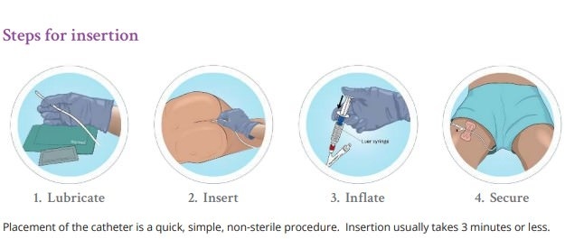 The Macy Catheter Rectal Medication Tube thumbnail 2