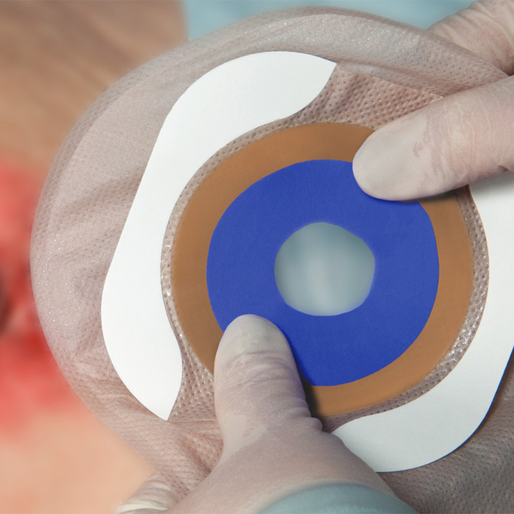 Hydrofera Blue Classic Antibacterial Foam Ostomy Dressing thumbnail 3