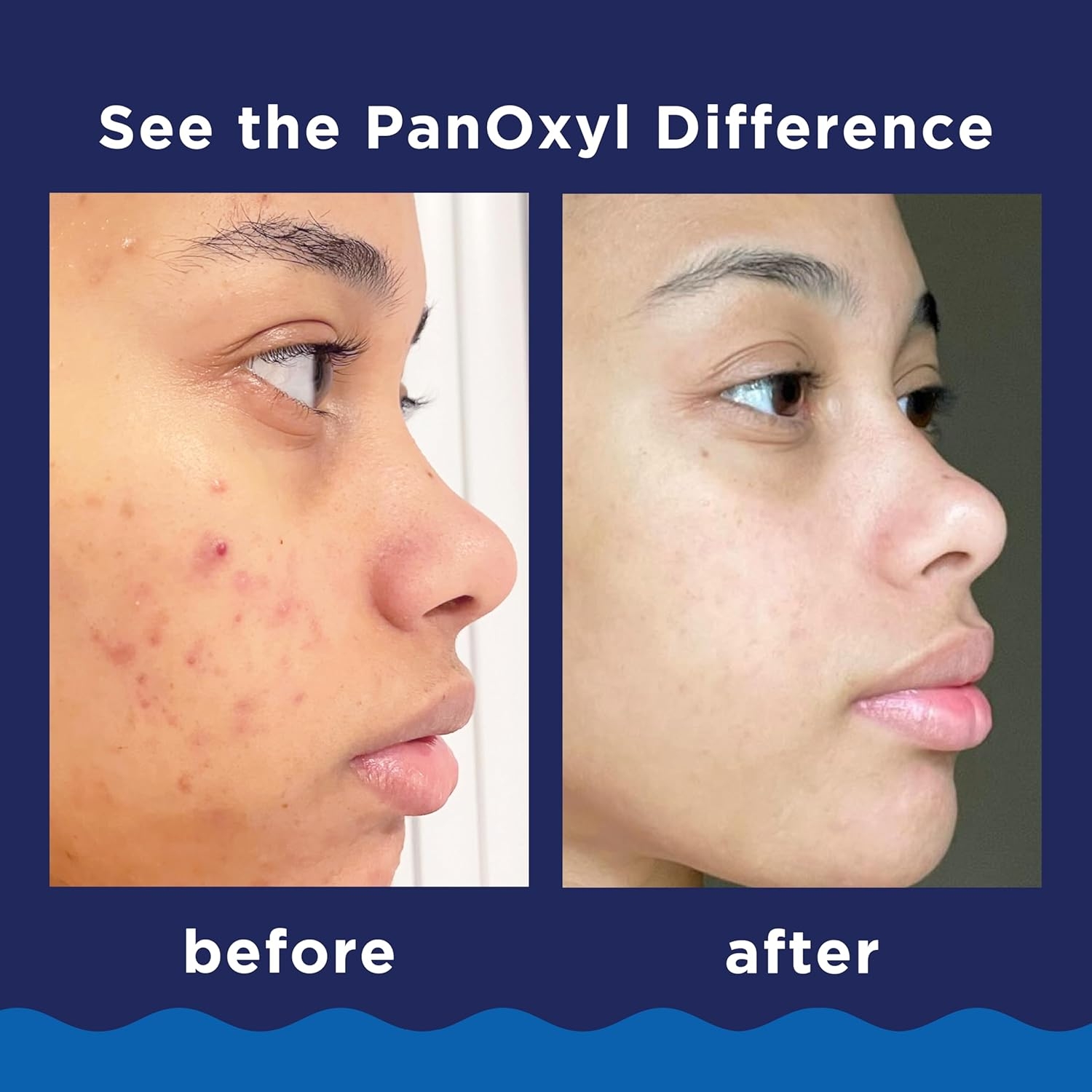 PanOxyl Acne Foaming Wash thumbnail 7