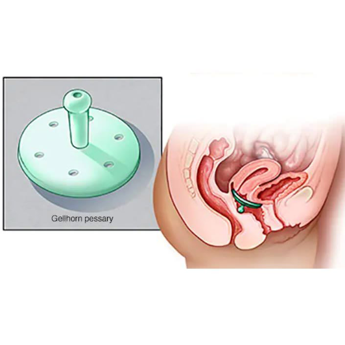 EvaCare Long Stem Gellhorn Pessary thumbnail 2