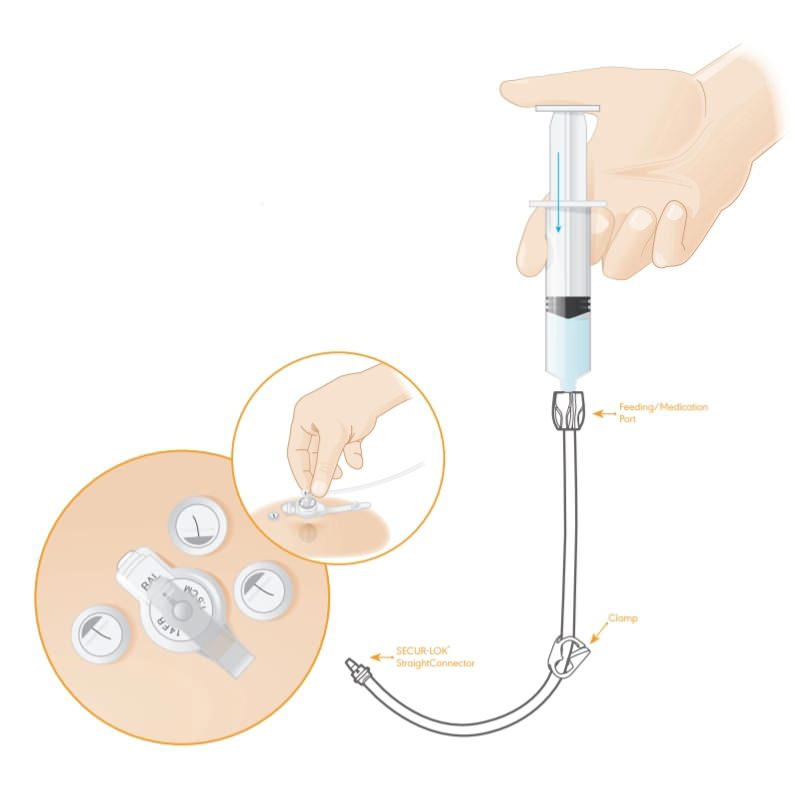 Mic-Key Gastrostomy Feeding Tube Kit thumbnail 4